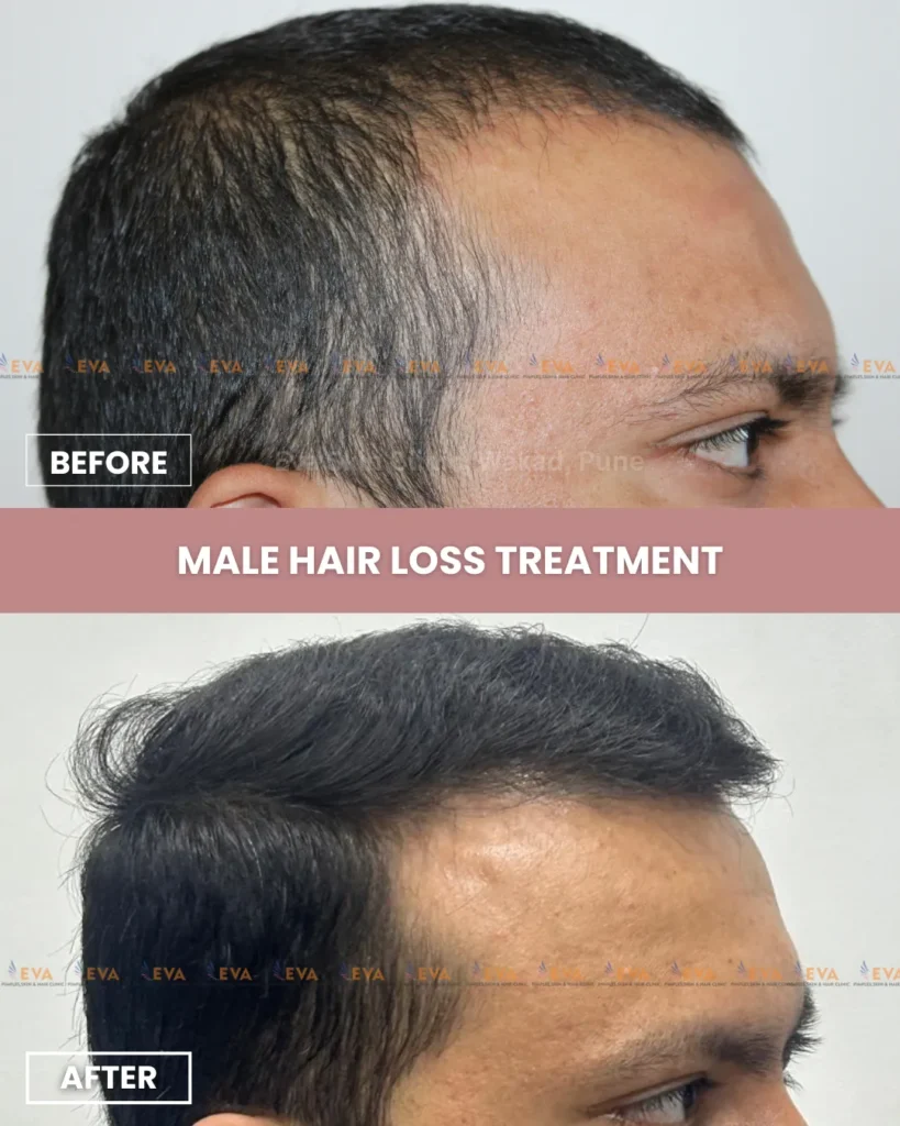 Male Hair Loss Treatment Wakad