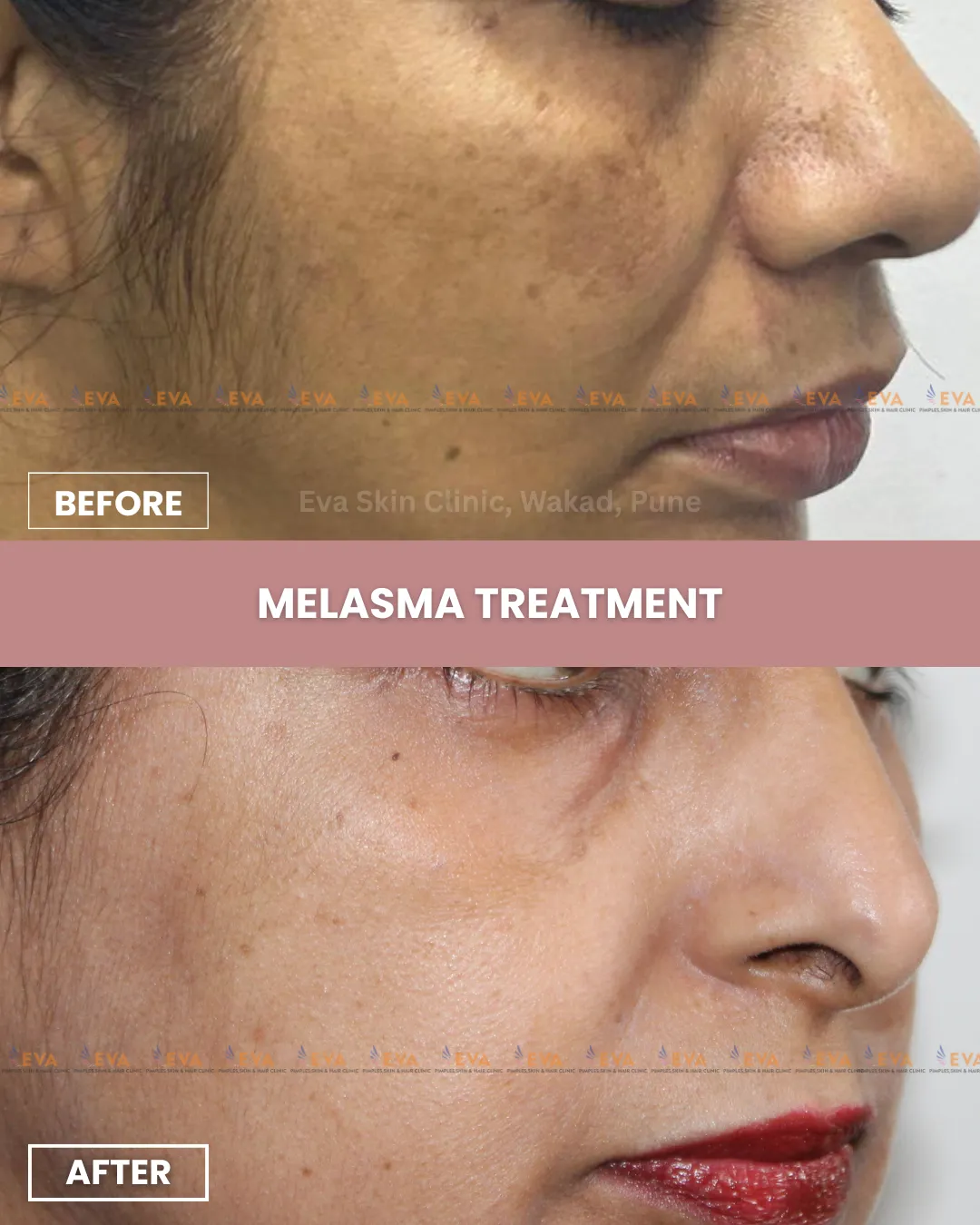 Melasma Treatment Results Wakad