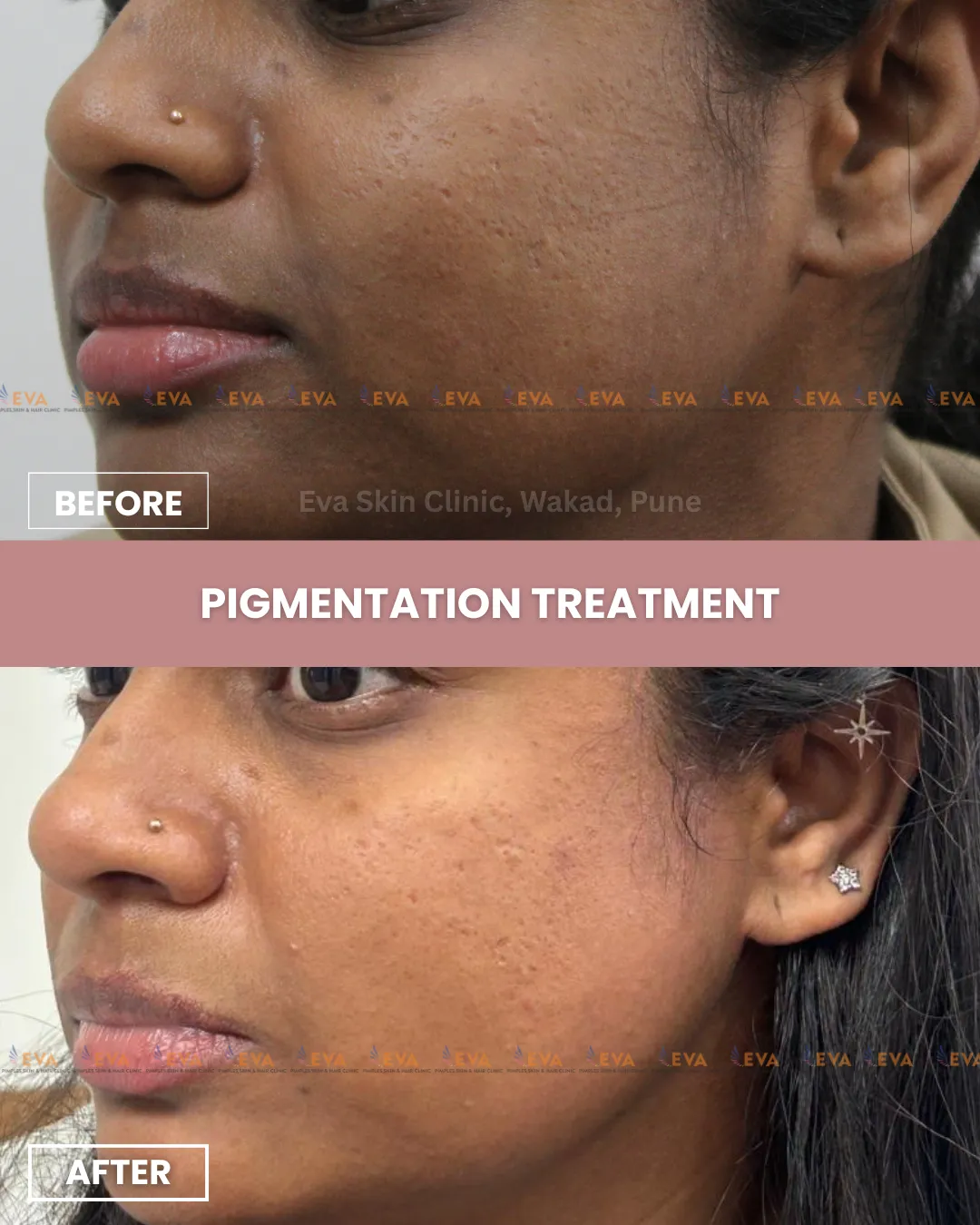 Pigmentation Treatment Results Wakad