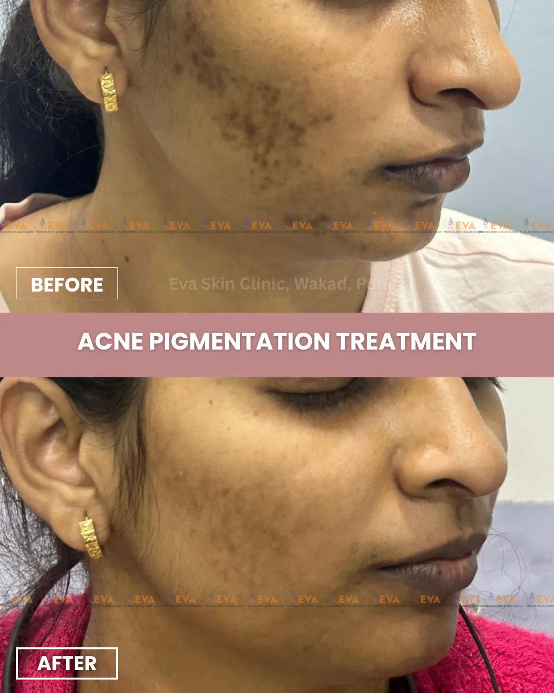 acne pigmentation treatment wakad