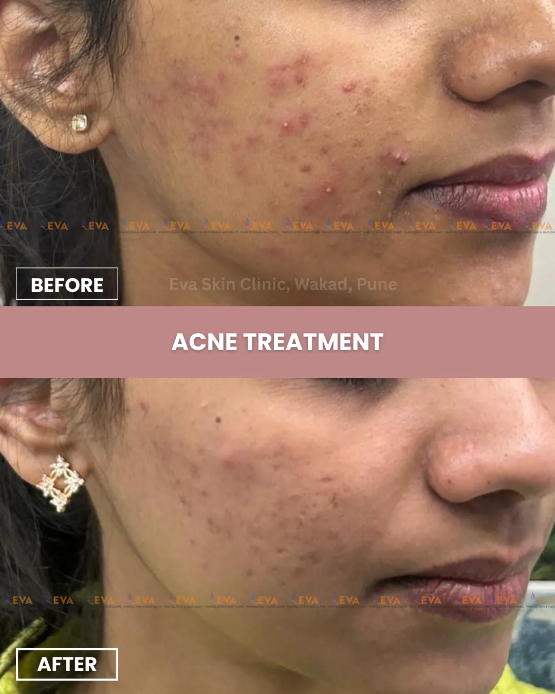 acne results pune