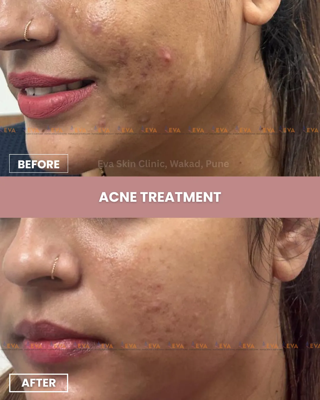 acne results