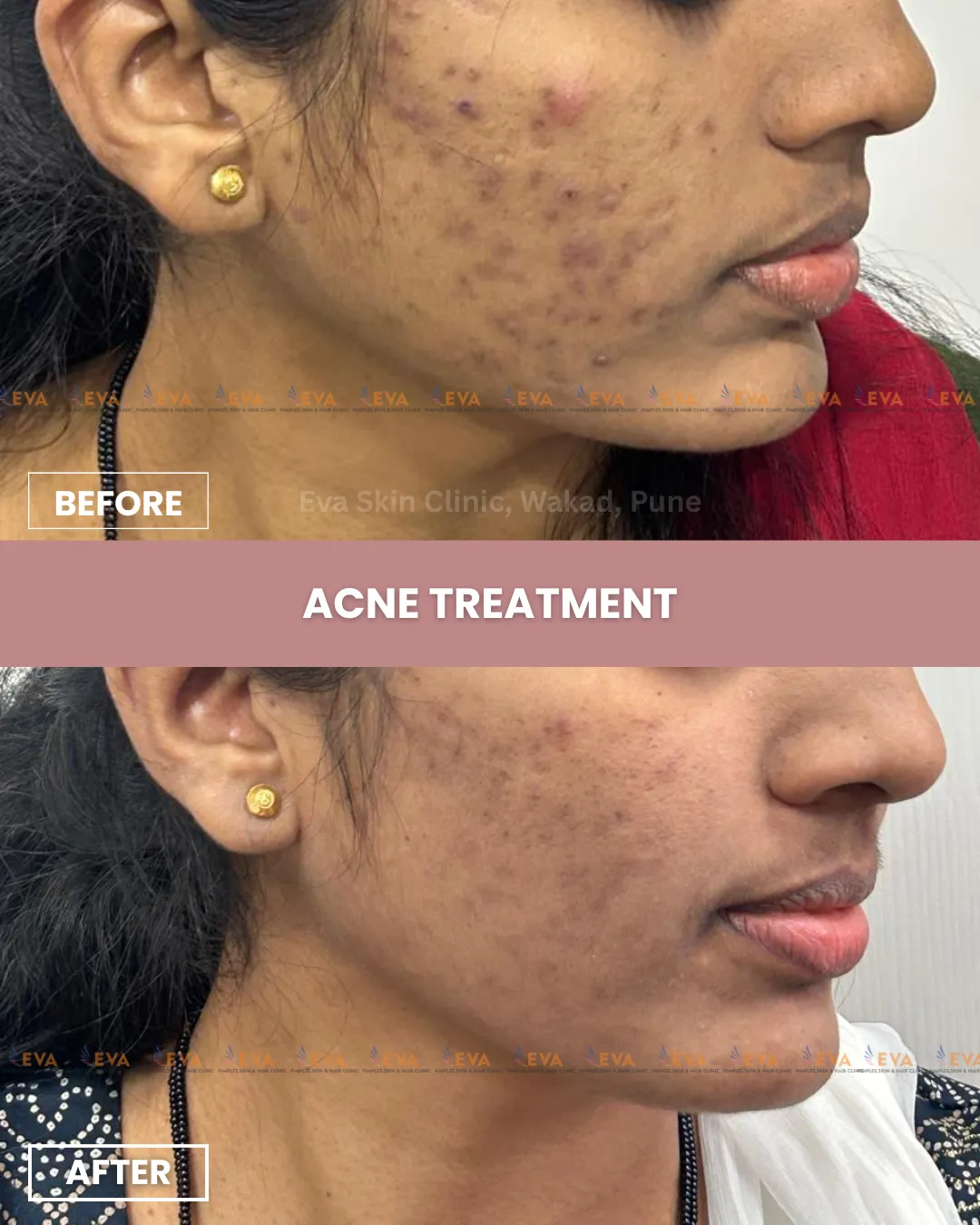 acne treatment in punawale