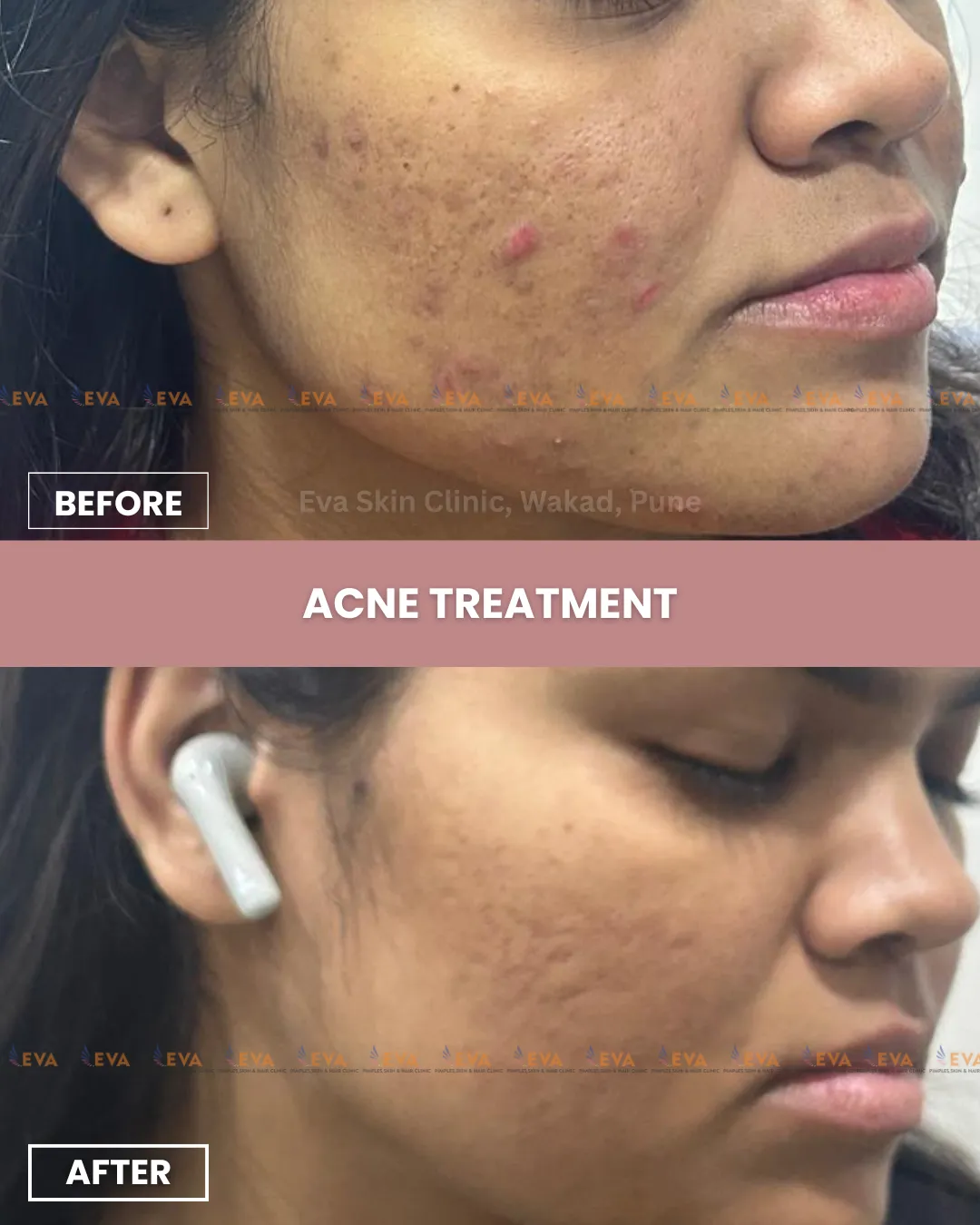 acne treatment in wakad