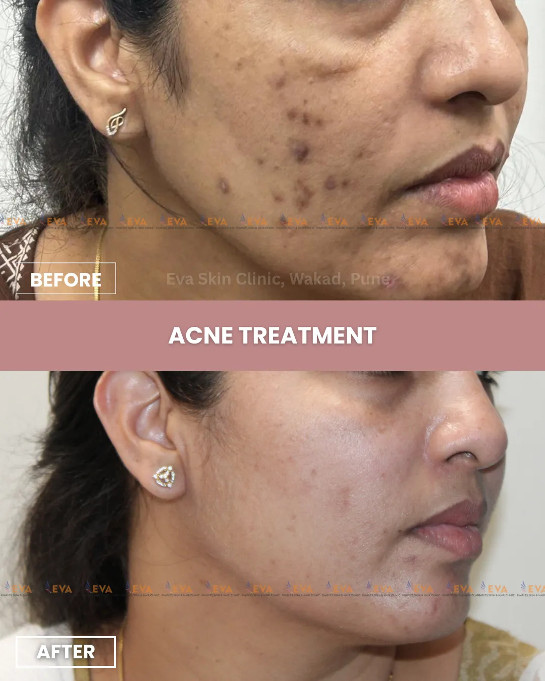 best acne treatment results by expert dermatologist