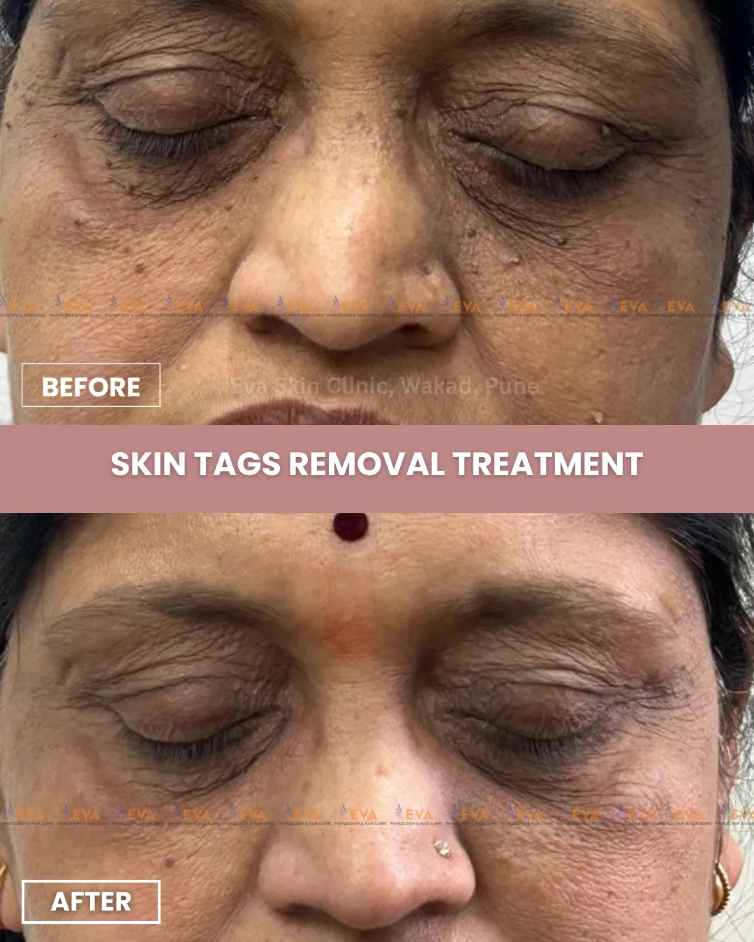 best skin tag removal results
