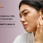 chemical peel for acne and acne scars-Eva Pimples SKin and hair clinic wakad