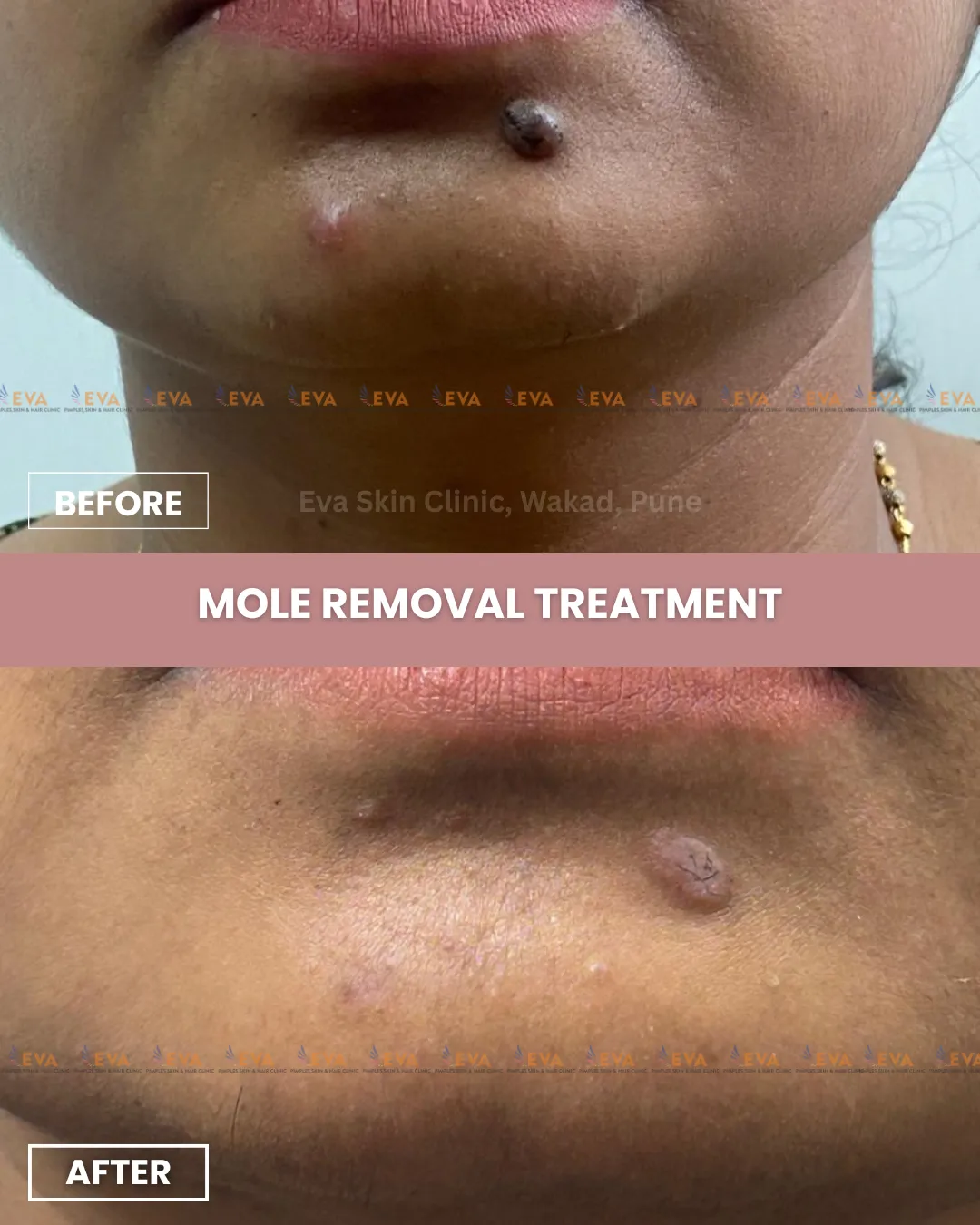 mole removal treatment in punawale