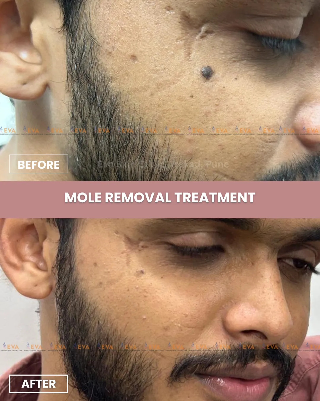 mole removal treatment results