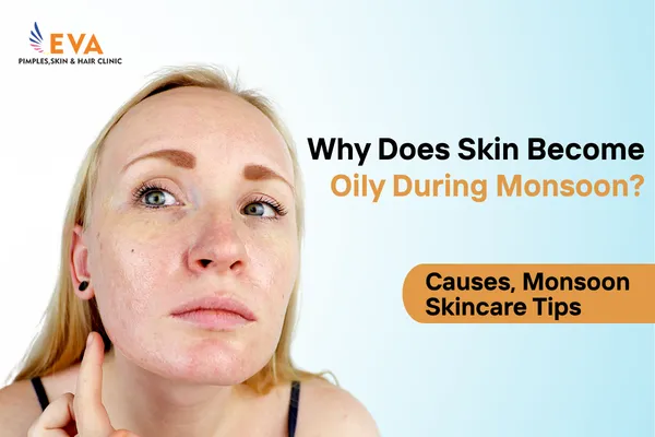 monsoon skincare for oily skin