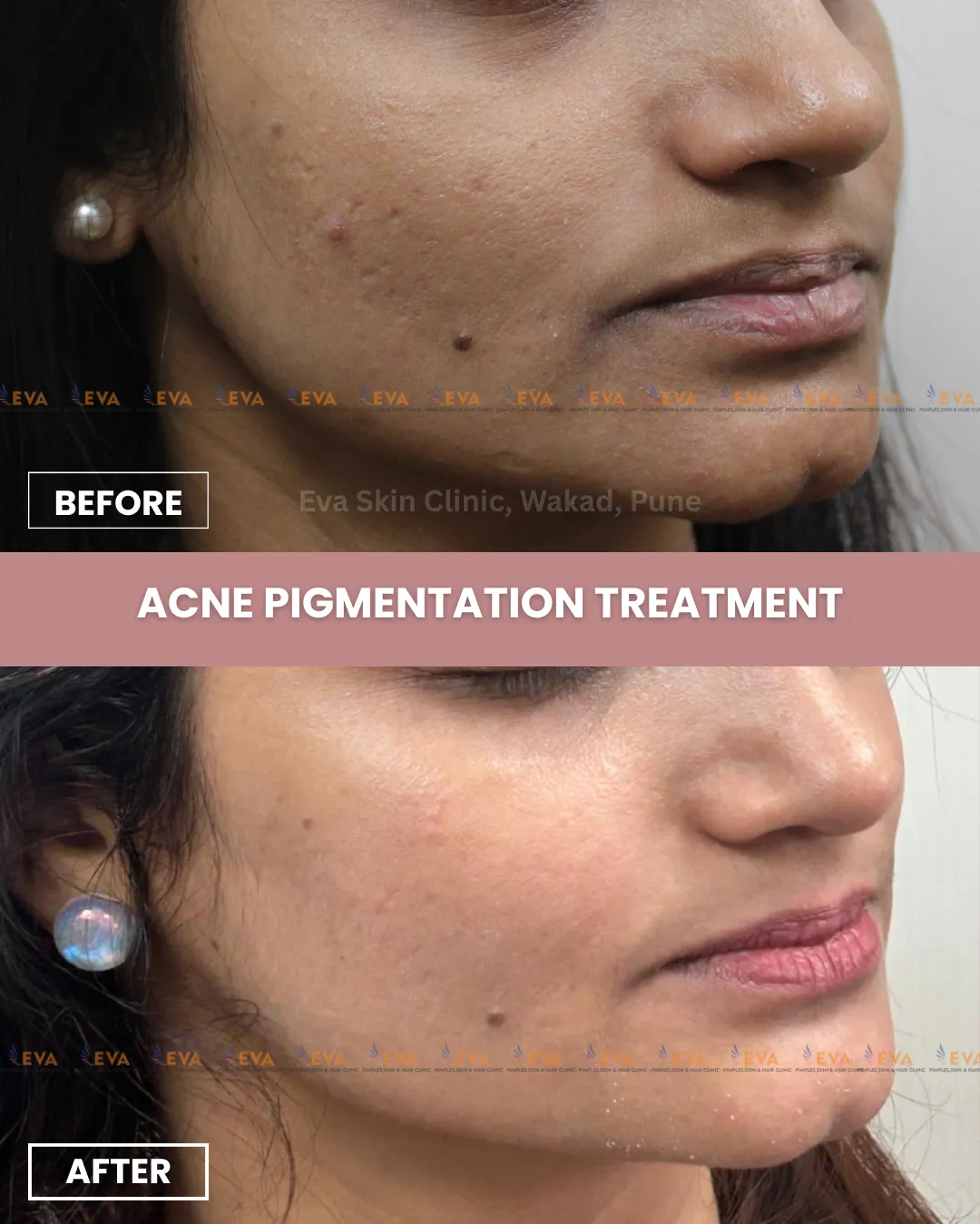 pigmentation treatment results punawale