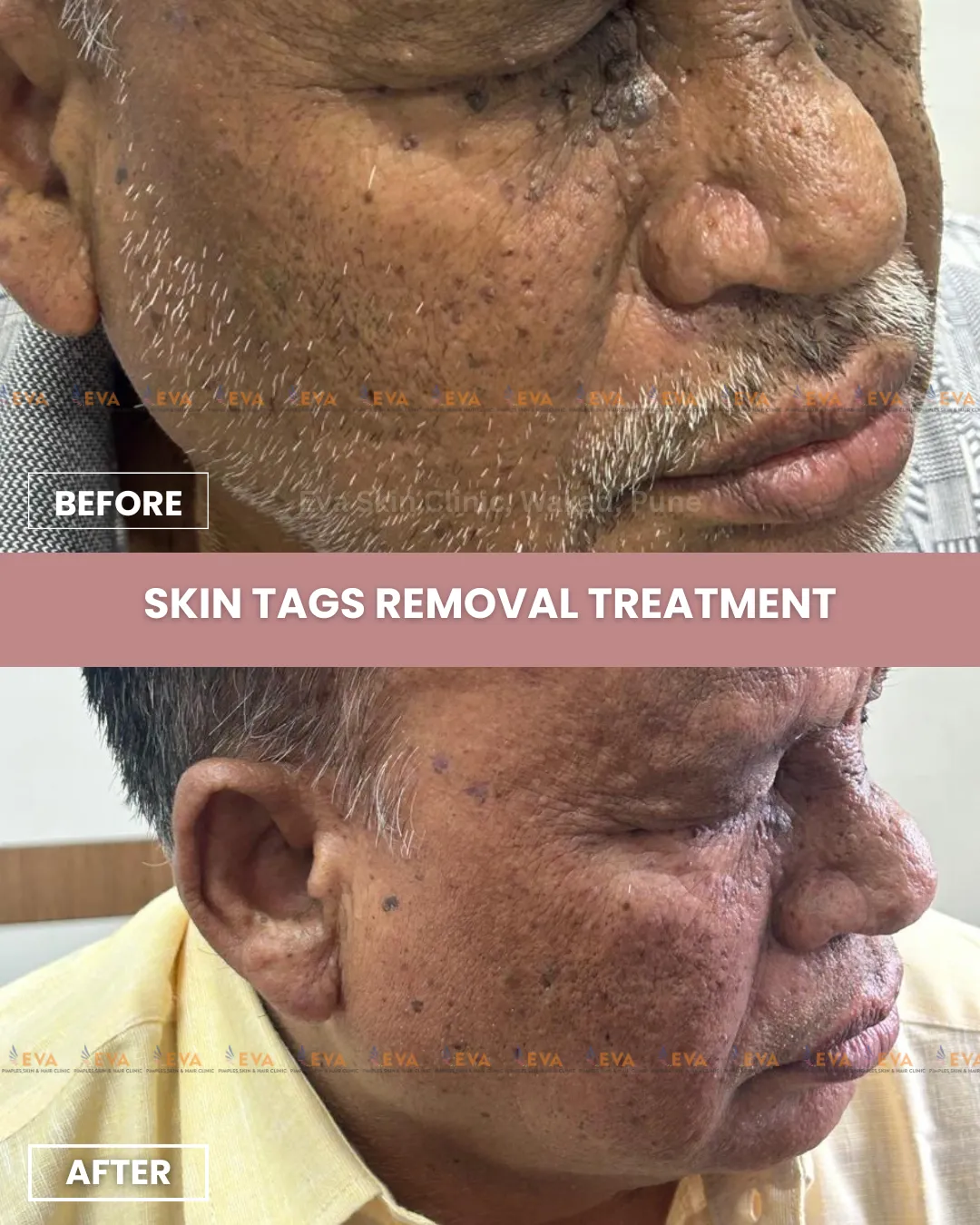 skin tag removal treatment punwale