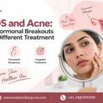 PCOS and Acne treatment pune