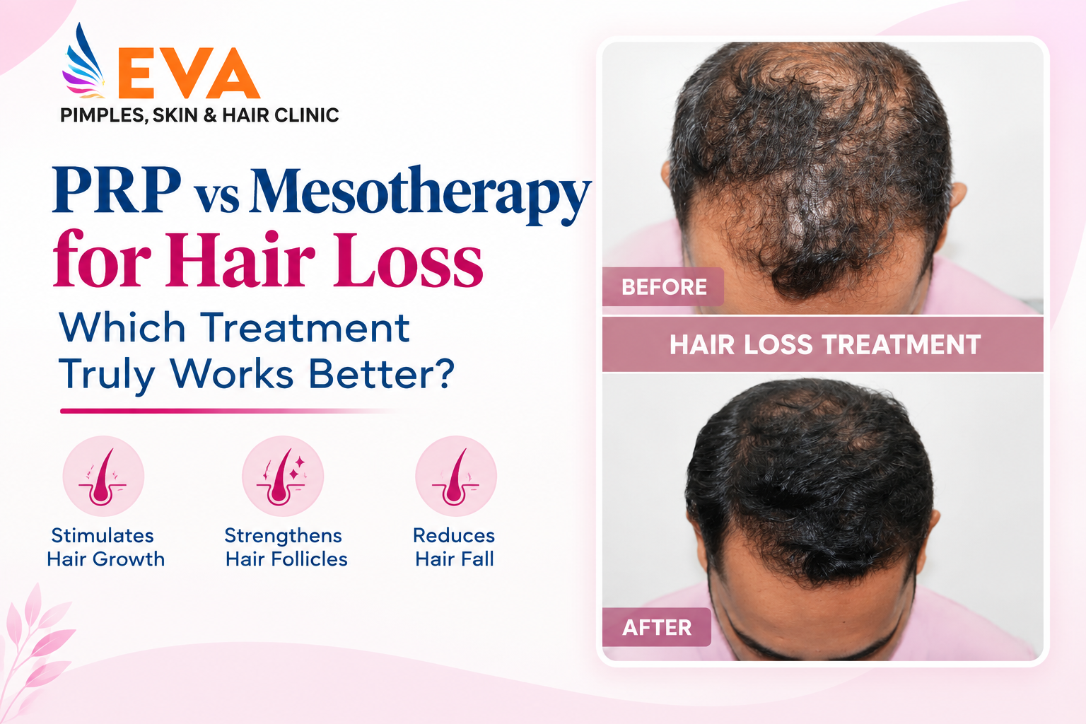 PRP vs Mesotherapy for Hair Loss  Which Treatment Truly Works Better