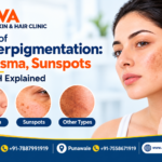 Skin Darkening and Hyperpigmentation Melasma, Sunspots, and PIH Explained