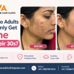 Adult Acne_ Before and After Care