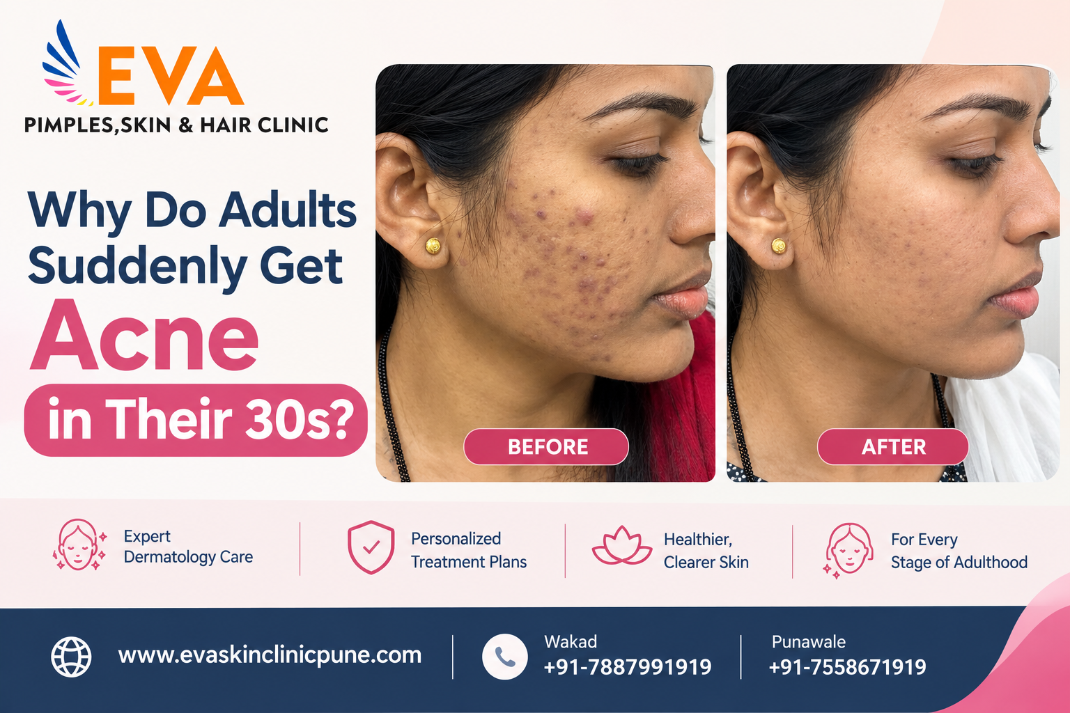 Adult Acne_ Before and After Care