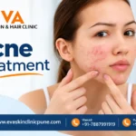 How Often Should You Wash Your Face If You Have Acne-Prone Skin?