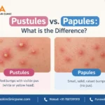 Pustules on Face: What They Are, Causes & Treatment by a Dermatologist