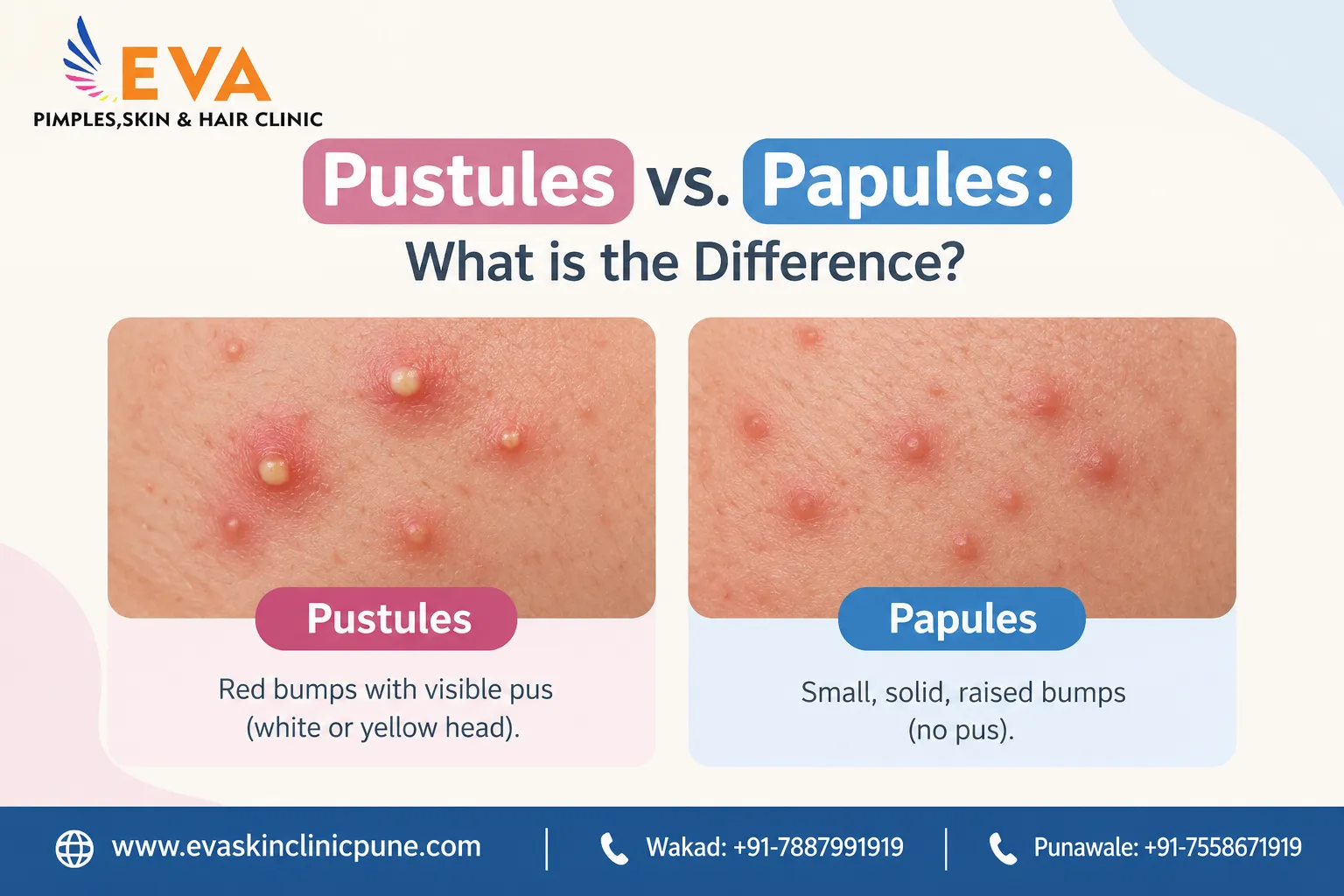 Pustules on Face: What They Are, Causes & Treatment by a Dermatologist